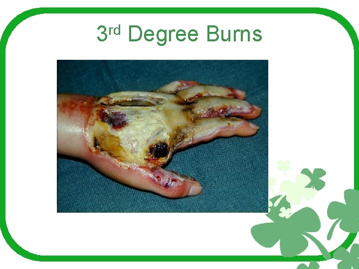 3 rd Degree Burns 