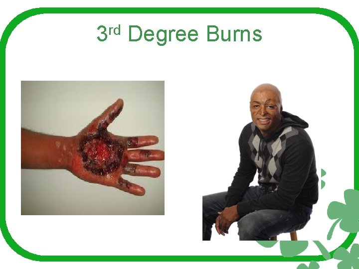 3 rd Degree Burns 