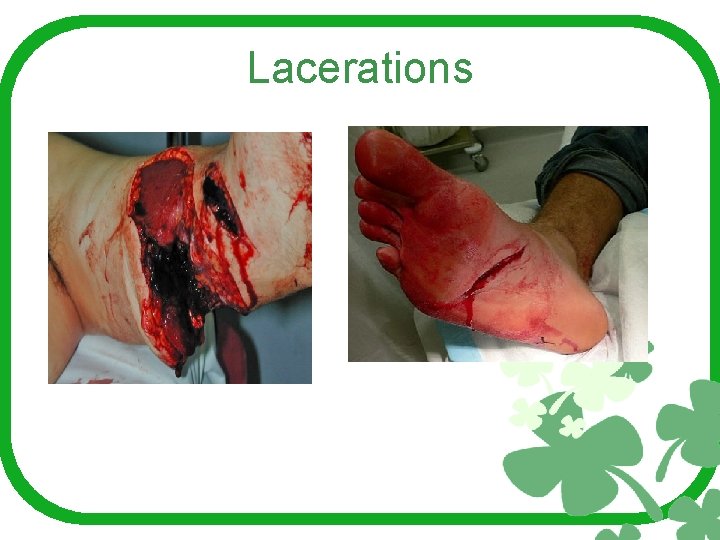 Lacerations 