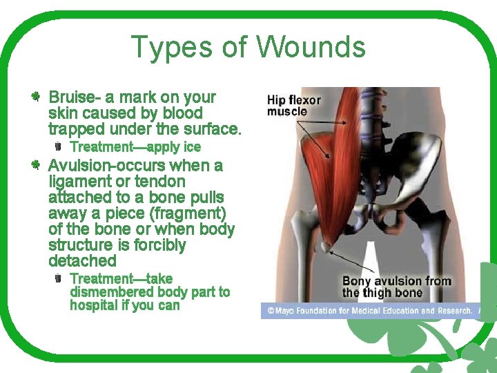 Types of Wounds Bruise- a mark on your skin caused by blood trapped under