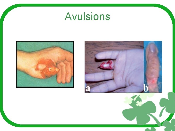 Avulsions 