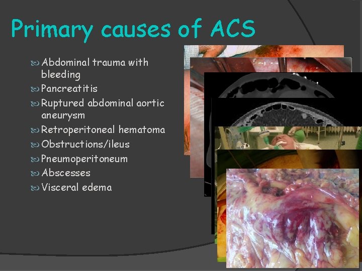 Primary causes of ACS Abdominal trauma with bleeding Pancreatitis Ruptured abdominal aortic aneurysm Retroperitoneal