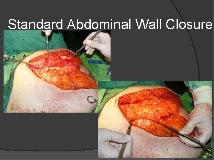 Standard Abdominal Wall Closure 