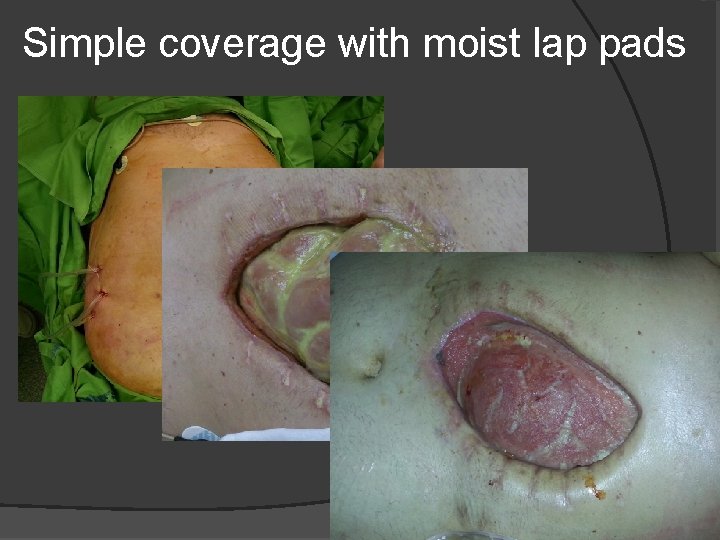 Simple coverage with moist lap pads 