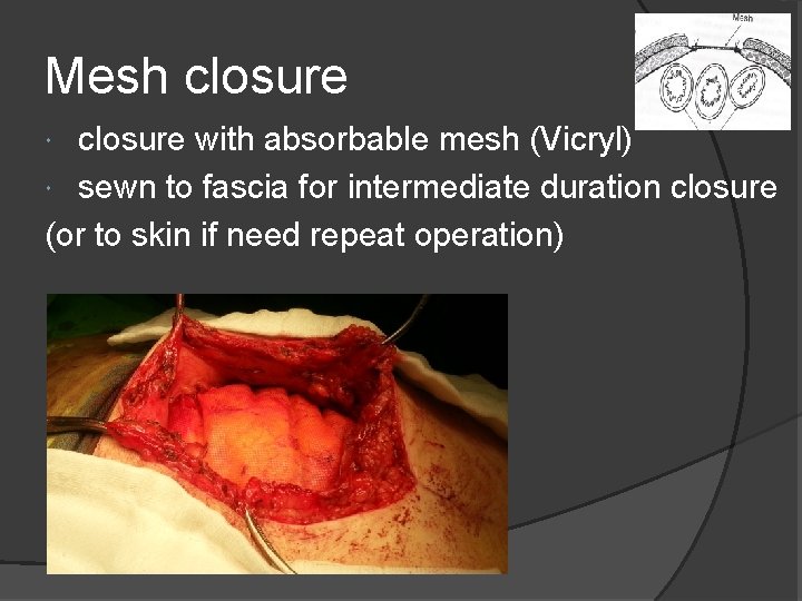 Mesh closure with absorbable mesh (Vicryl) sewn to fascia for intermediate duration closure (or