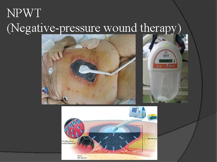 NPWT (Negative-pressure wound therapy) 