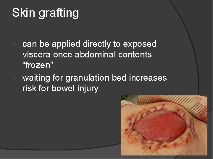 Skin grafting can be applied directly to exposed viscera once abdominal contents “frozen” waiting