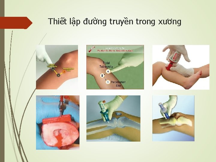 Thiết lập đường truyền trong xương 