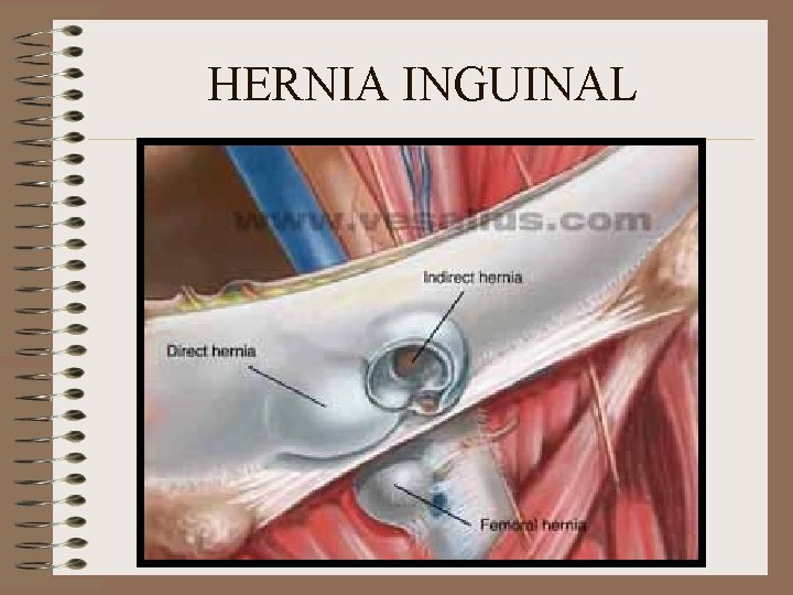 HERNIA INGUINAL 