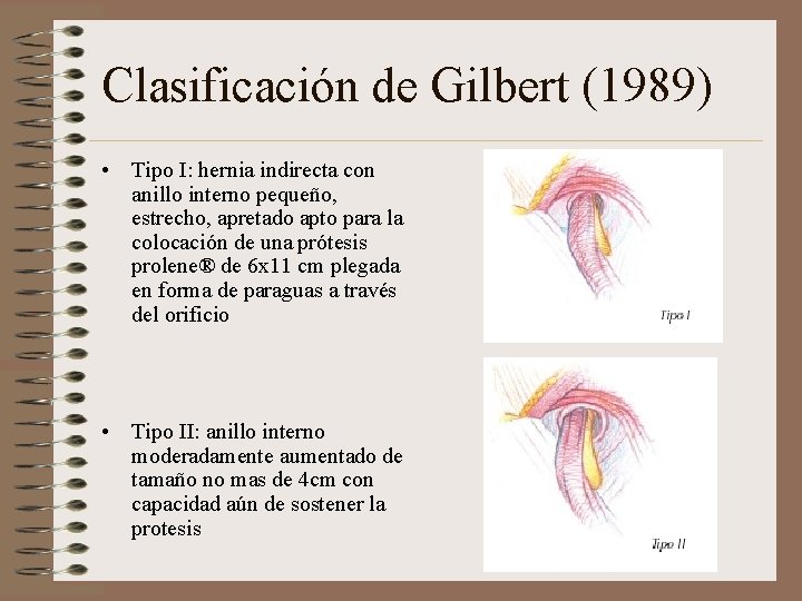 Clasificación de Gilbert (1989) • Tipo I: hernia indirecta con anillo interno pequeño, estrecho,