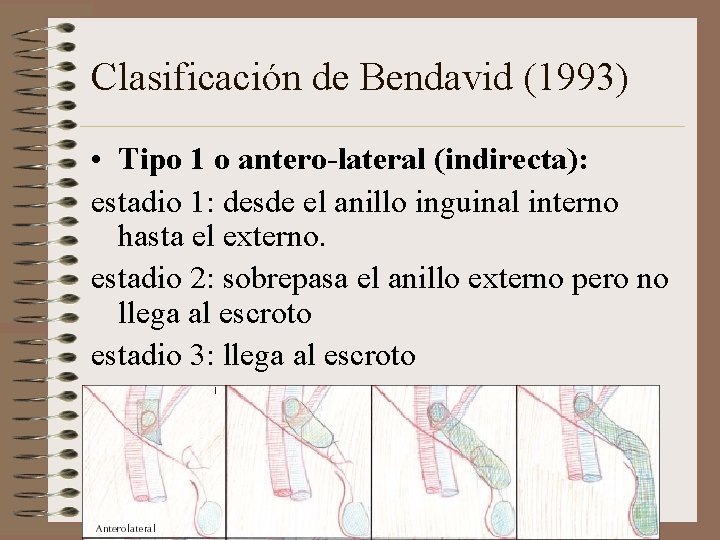 Clasificación de Bendavid (1993) • Tipo 1 o antero-lateral (indirecta): estadio 1: desde el