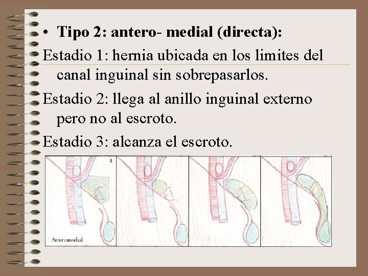  • Tipo 2: antero- medial (directa): Estadio 1: hernia ubicada en los limites