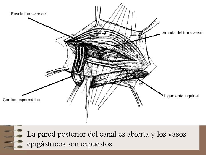 La pared posterior del canal es abierta y los vasos epigástricos son expuestos. 