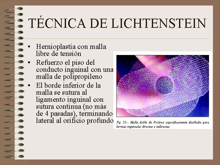 TÉCNICA DE LICHTENSTEIN • Hernioplastia con malla libre de tensión • Refuerzo el piso