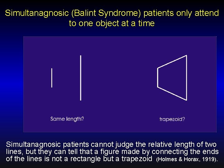 Simultanagnosic (Balint Syndrome) patients only attend to one object at a time Simultanagnosic patients