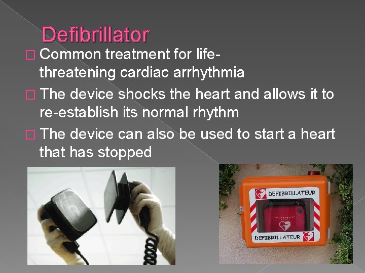 Defibrillator � Common treatment for lifethreatening cardiac arrhythmia � The device shocks the heart