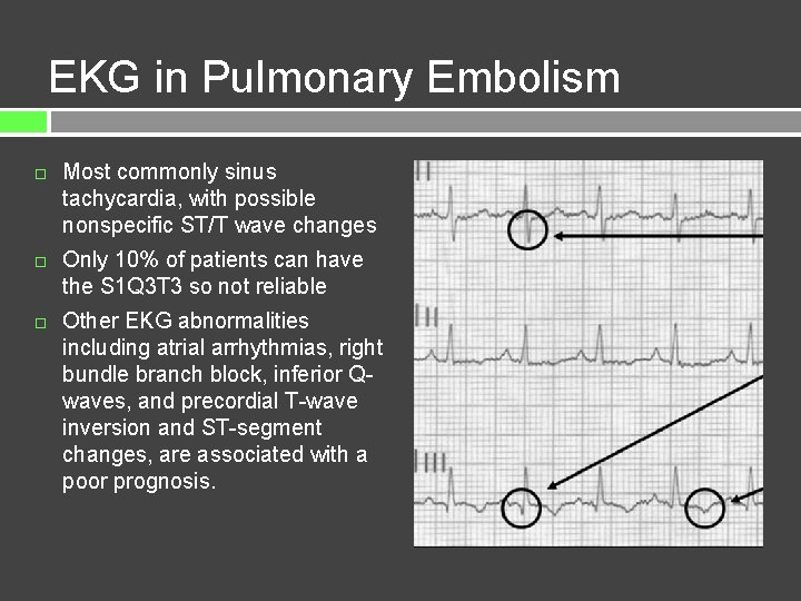EKG in Pulmonary Embolism Most commonly sinus tachycardia, with possible nonspecific ST/T wave changes