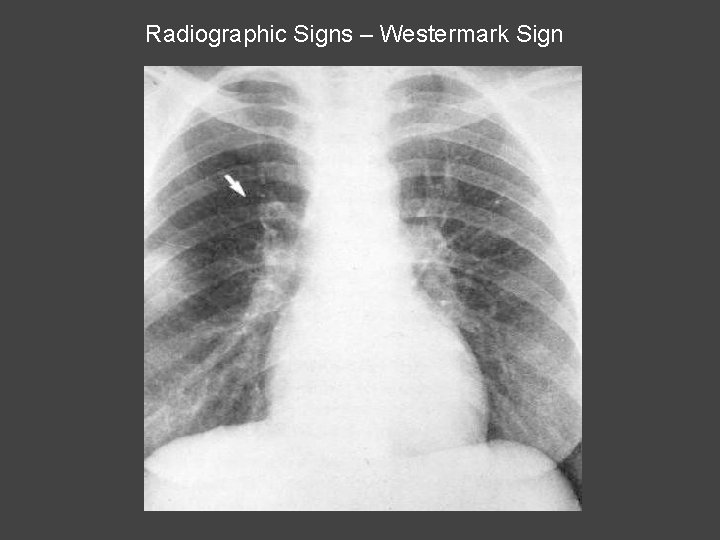Radiographic Signs – Westermark Sign 