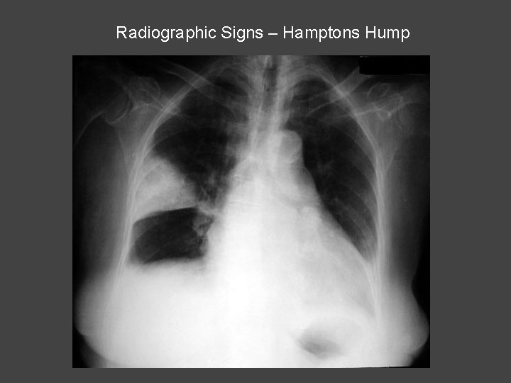 Radiographic Signs – Hamptons Hump 