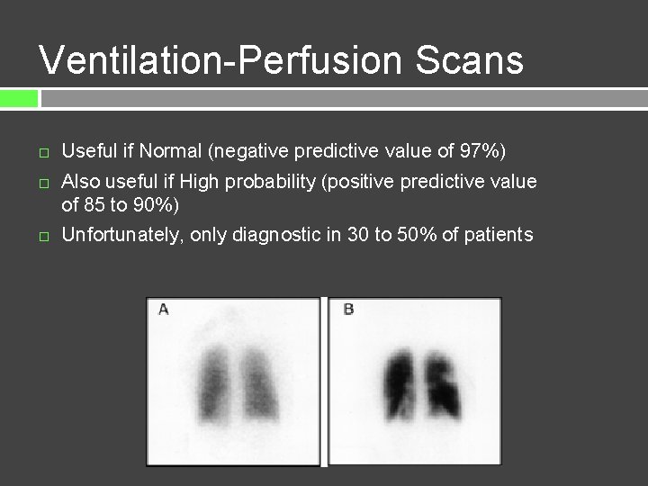 Ventilation-Perfusion Scans Useful if Normal (negative predictive value of 97%) Also useful if High