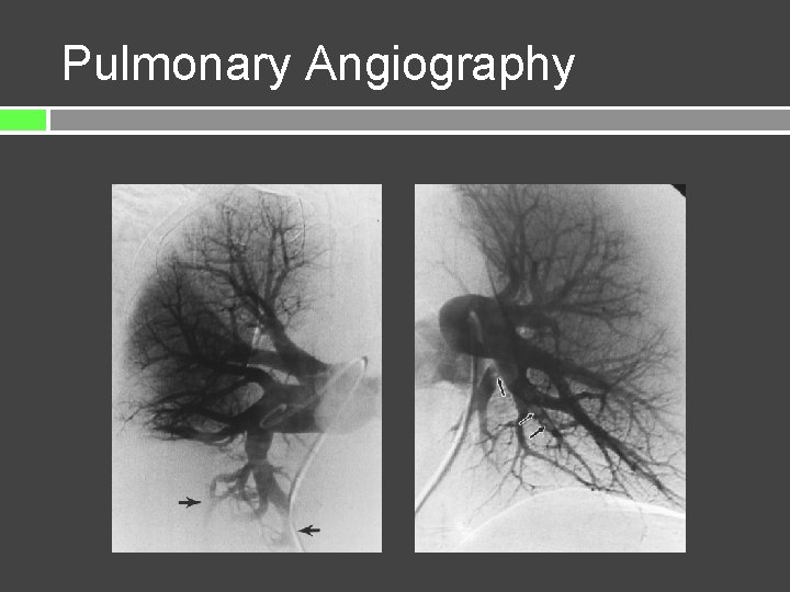 Pulmonary Angiography 