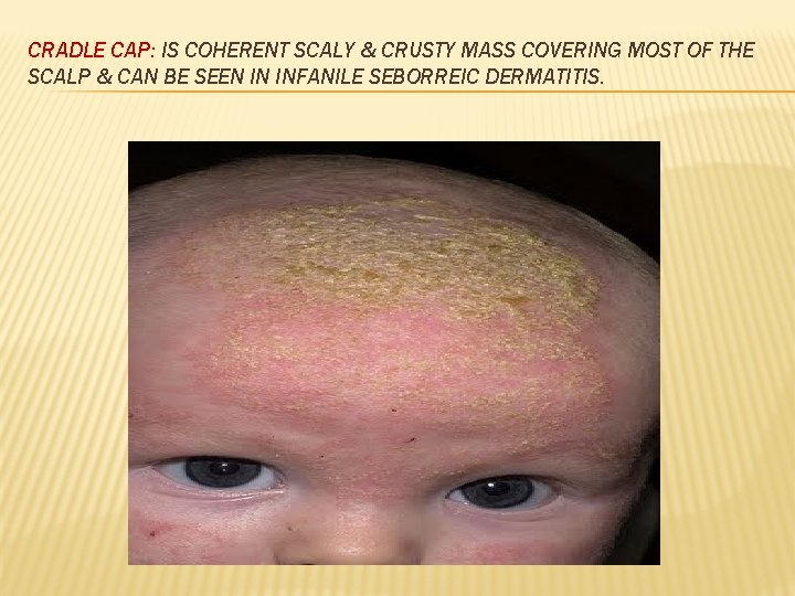 CRADLE CAP: IS COHERENT SCALY & CRUSTY MASS COVERING MOST OF THE SCALP &