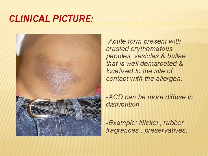 CLINICAL PICTURE: -Acute form present with crusted erythematous papules, vesicles & bullae that is
