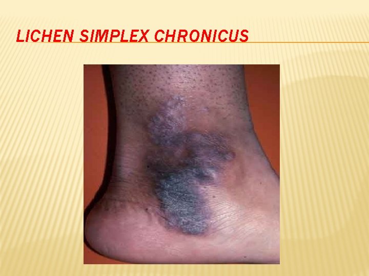 LICHEN SIMPLEX CHRONICUS 