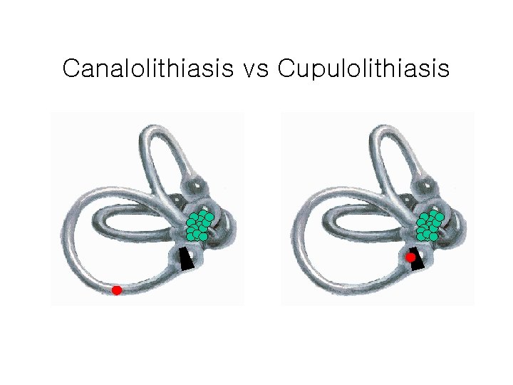 Canalolithiasis vs Cupulolithiasis 