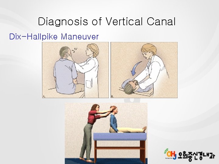 Diagnosis of Vertical Canal Dix-Hallpike Maneuver 