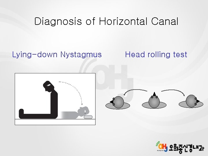 Diagnosis of Horizontal Canal Lying-down Nystagmus Head rolling test 