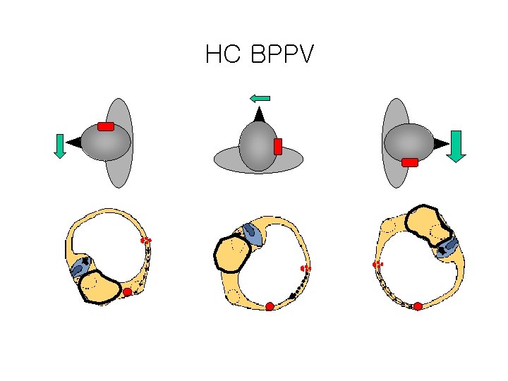 HC BPPV 