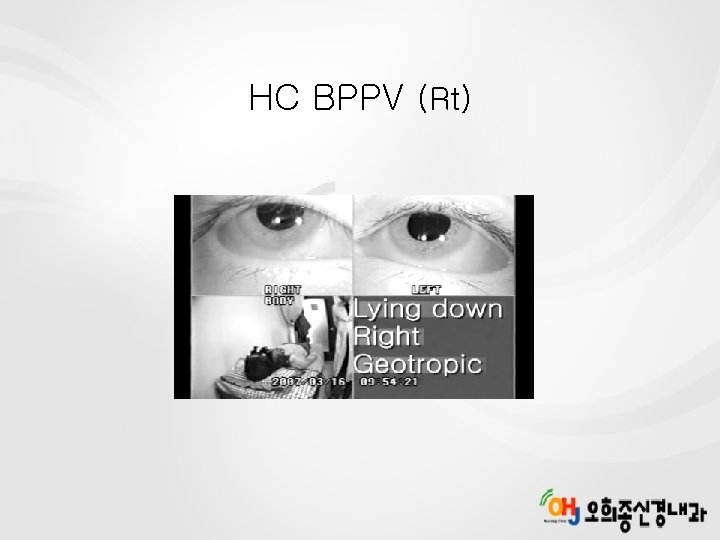 HC BPPV (Rt) 