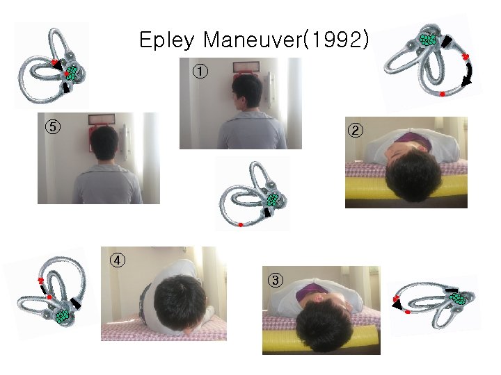 Epley Maneuver(1992) ① ⑤ ② ④ ③ 