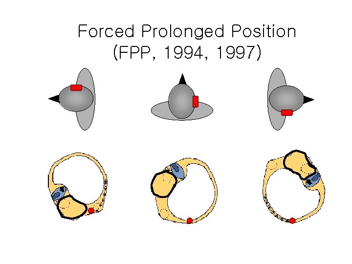 Forced Prolonged Position (FPP, 1994, 1997) 