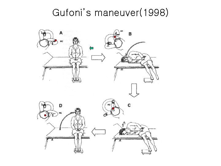 Gufoni’s maneuver(1998) 