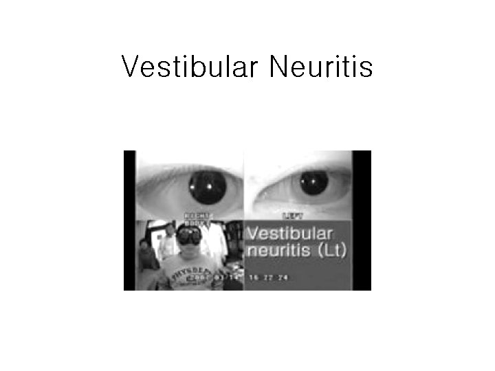 Vestibular Neuritis 