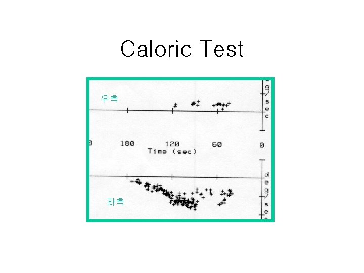 Caloric Test 우측 좌측 