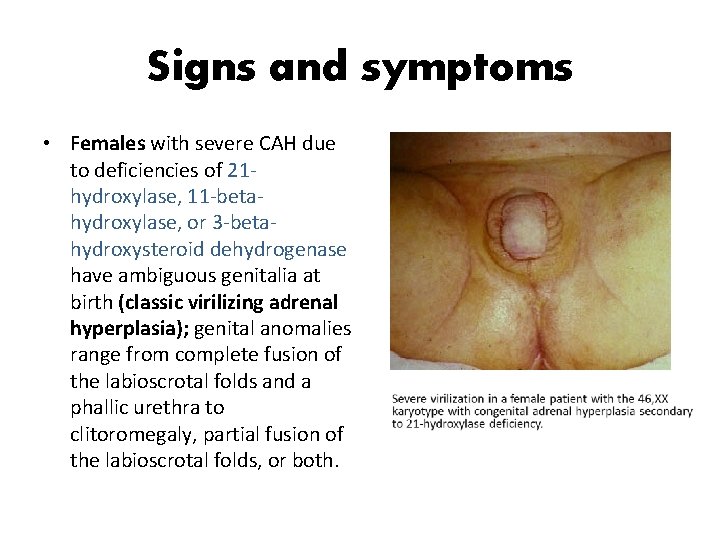 Signs and symptoms • Females with severe CAH due to deficiencies of 21 hydroxylase,