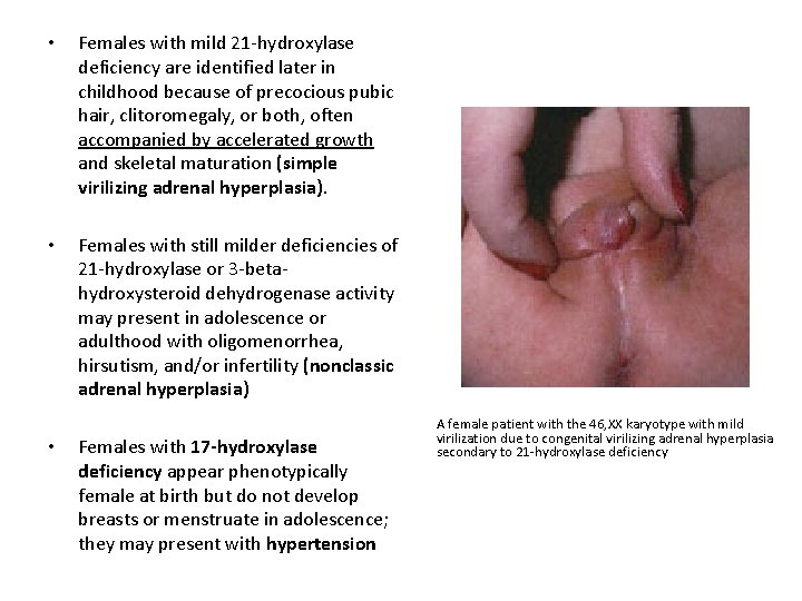  • Females with mild 21 -hydroxylase deficiency are identified later in childhood because
