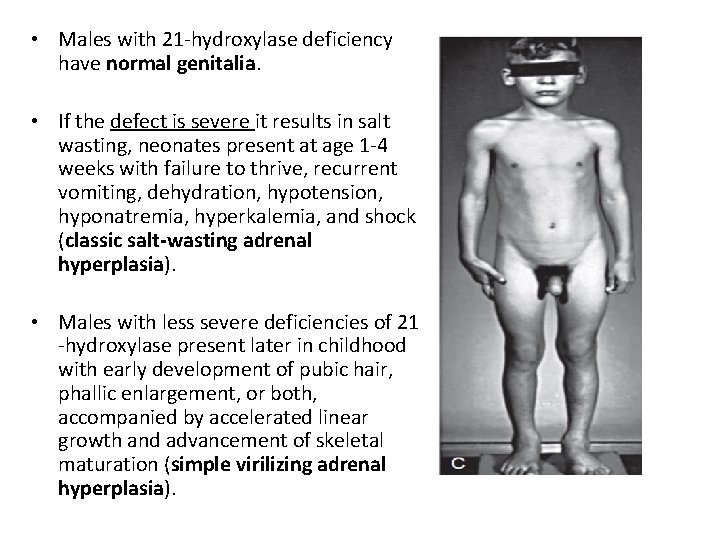  • Males with 21 -hydroxylase deficiency have normal genitalia. • If the defect