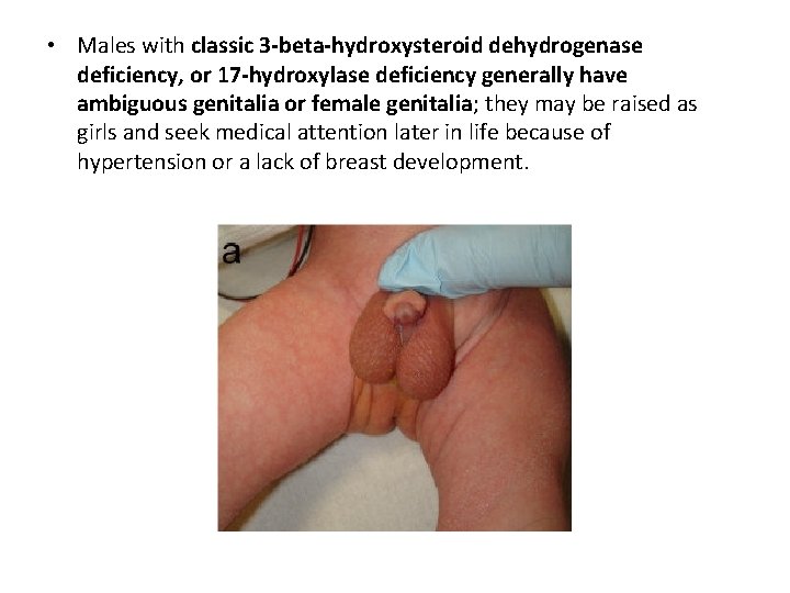  • Males with classic 3 -beta-hydroxysteroid dehydrogenase deficiency, or 17 -hydroxylase deficiency generally