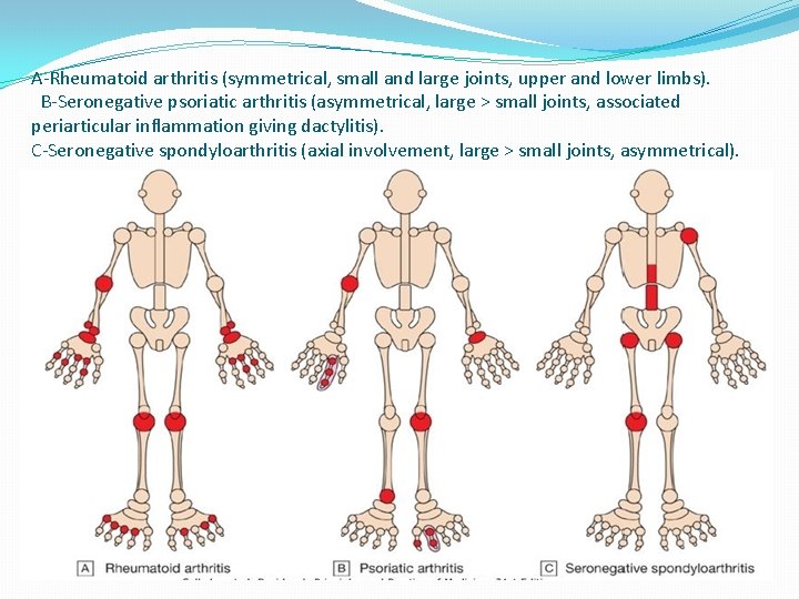 A-Rheumatoid arthritis (symmetrical, small and large joints, upper and lower limbs). B-Seronegative psoriatic arthritis