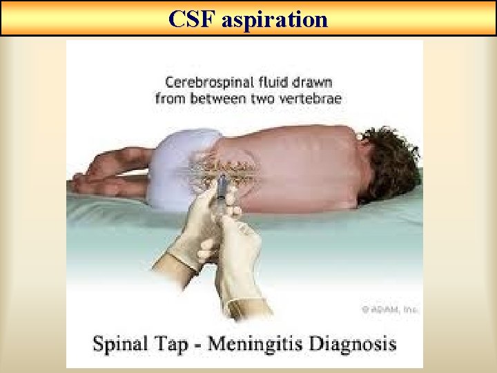 CSF aspiration CSF aspiration