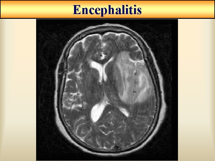 Encephalitis Encephalitis