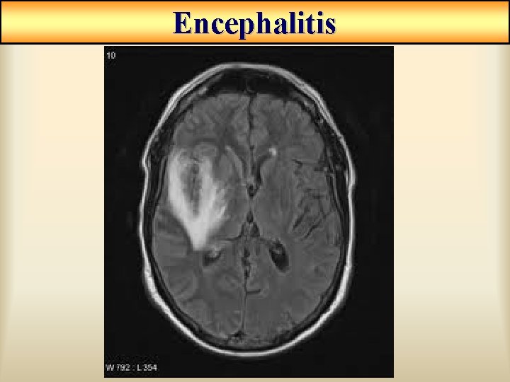 Encephalitis Encephalitis