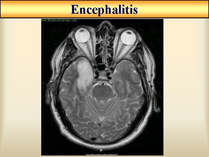 Encephalitis Encephalitis