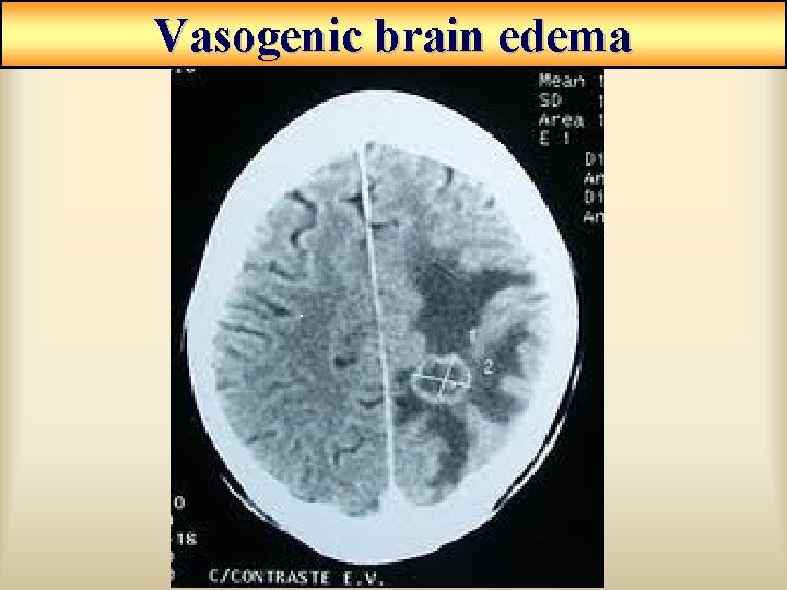 Vasogenic brain edema Vasogenic brain edema