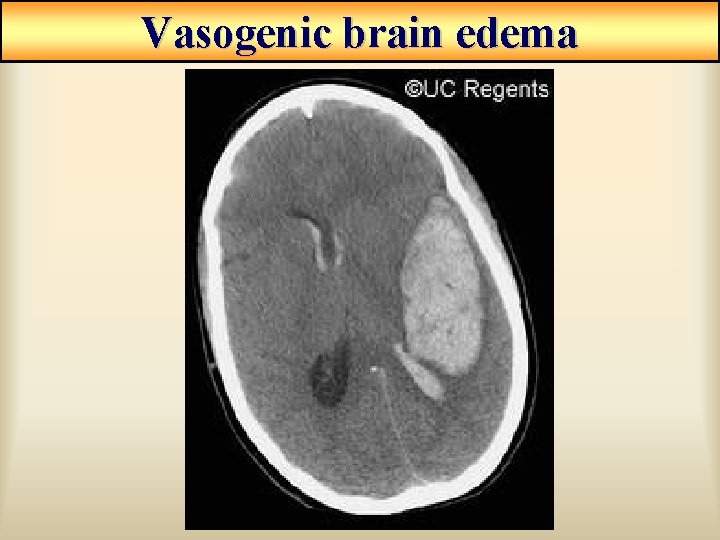 Vasogenic brain edema Vasogenic brain edema