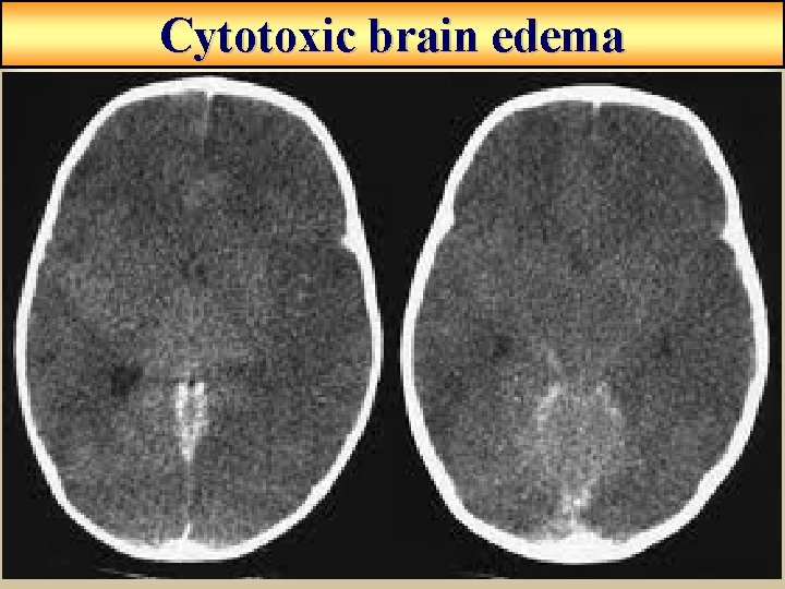 Cytotoxic brain edema Cytotoxic brain edema
